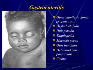 Gastroenteritis
Otras manifestaciones
propias son
Deshidratación
Hipotensión
Taquicardia
Mucosas secas
Ojos hundidos
Debilidad con
postración
Fiebre
 