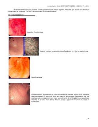 Arlindo Ugulino Netto – GASTROENTEROLOGIA – MEDICINA P7 – 2010.2
226
No exame endoscópico o paciente vai se apresentar com pregas gigantes, fato este que leva a uma absorção
inadequada de proteínas. Por isso é acompanhada de hipoalbuminemia.
IMAGENS ENDOSC‚PICAS
Gastrites Enantemática.
Gastrite nodular, característica de infecção por H. Pylori na fase crônica.
Gastrite erosiva.
Gastrite atrófica. Apresentam-se com mucosa lisa e brilhosa, sendo muito freqüente
nas infecções por H. pylori ou ainda em doenças auto-imunes. Salientando que nas
doenças auto-imunes ocorre um maior acometimento do fundo gástrico, enquanto por
infecção H. pylori é mais difusa. Nesses casos é possível visualizar os vasos da
submucosa.
 