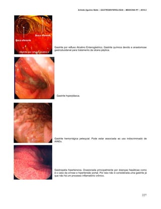 Arlindo Ugulino Netto – GASTROENTEROLOGIA – MEDICINA P7 – 2010.2
227
Gastrite por refluxo Alcalino Enterogástrico. Gastrite química devido a anastomose
gastroduodenal para tratamento de úlcera péptica.
Gastrite hiperplásica.
Gastrite hemorrágica petequial. Pode estar associada ao uso indiscriminado de
AINEs.
Gastropatia hipertensiva. Ocasionada principalmente por doenças hepáticas como
é o caso da cirrose e hipertensão portal. Por isso não é considerada uma gastrite já
que não há um processo inflamatório crônico.
 