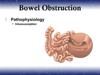 Intestinal Interception Gastroenterology | PPT