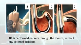 Tif Device GASTROESOPHAGEAL REFLUX DISEASE.pptx for bsc nursing | PPTX