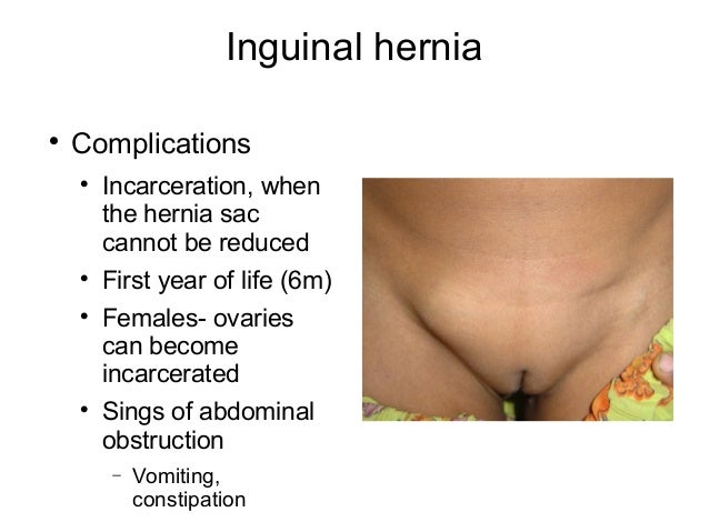 Bilateral Inguinal Hernia In Supine Position With Active Cough