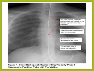 Intestinal Intubation Gastrointestinal-Intubation-1.pptx