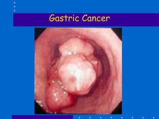 Gastric Cancer 
