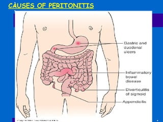 CAUSES OF PERITONITIS 