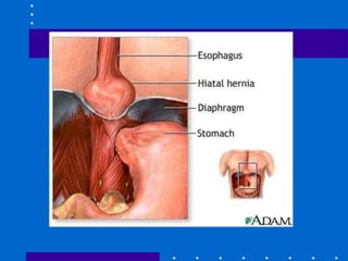 Clinical Manifestations
 nausea and vomiting – occurs more often in gastric ulcer
 anorexia
 eructation (belching)
 we...