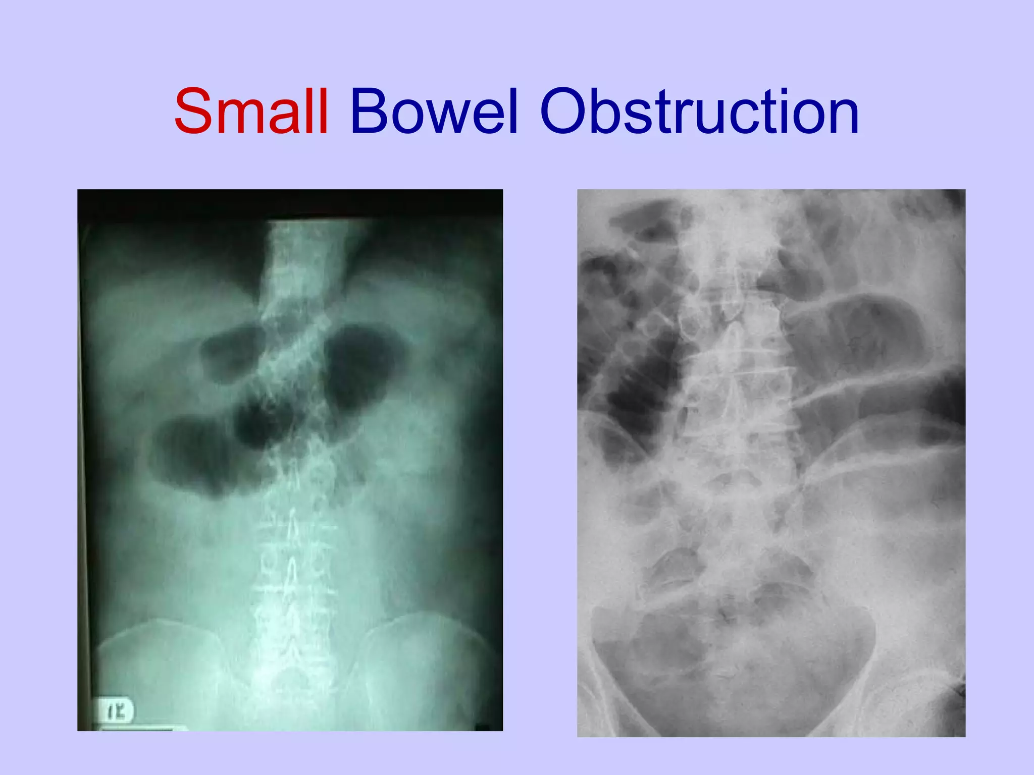 Small  Bowel Obstruction 