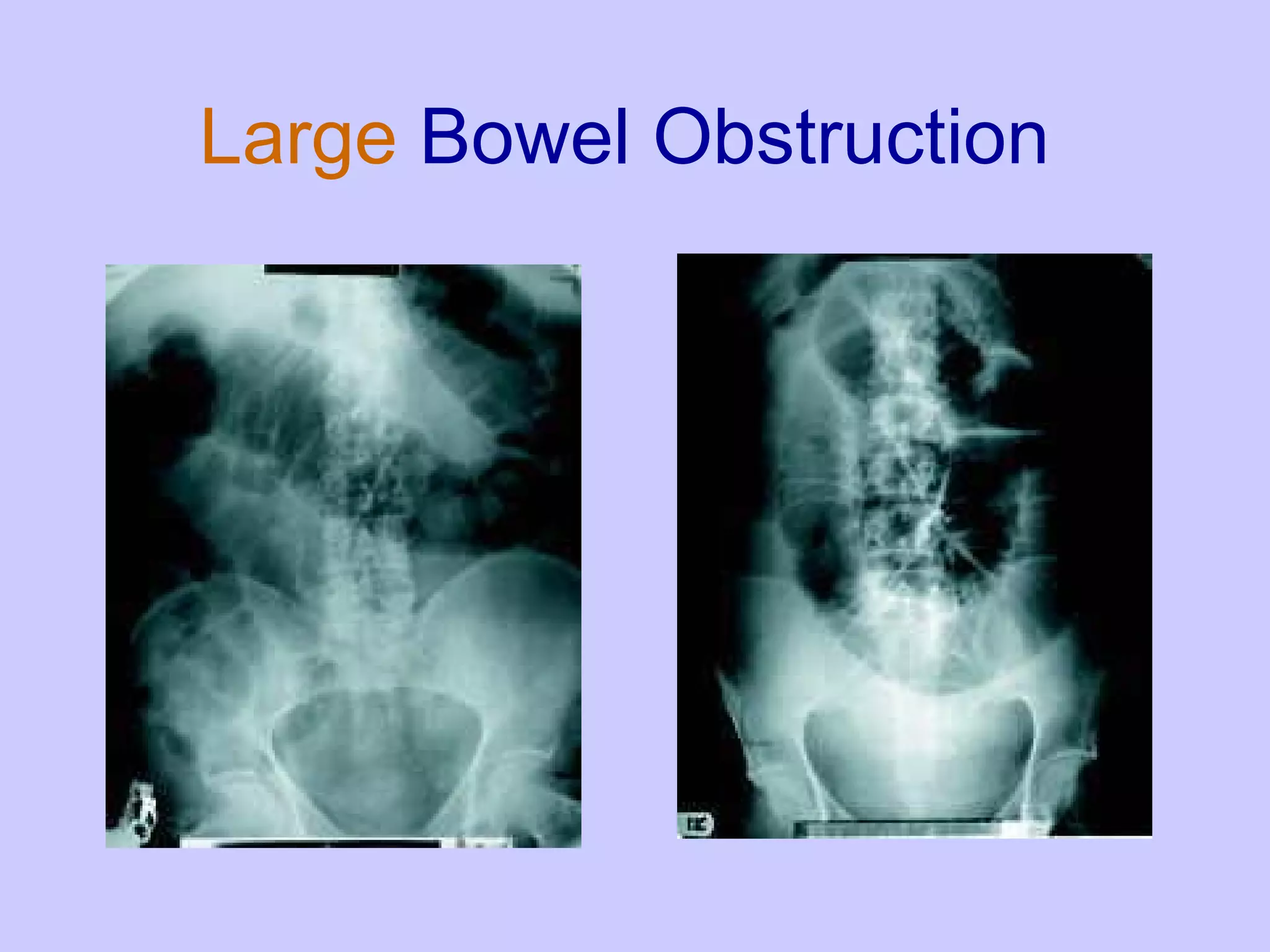 Large  Bowel Obstruction 
