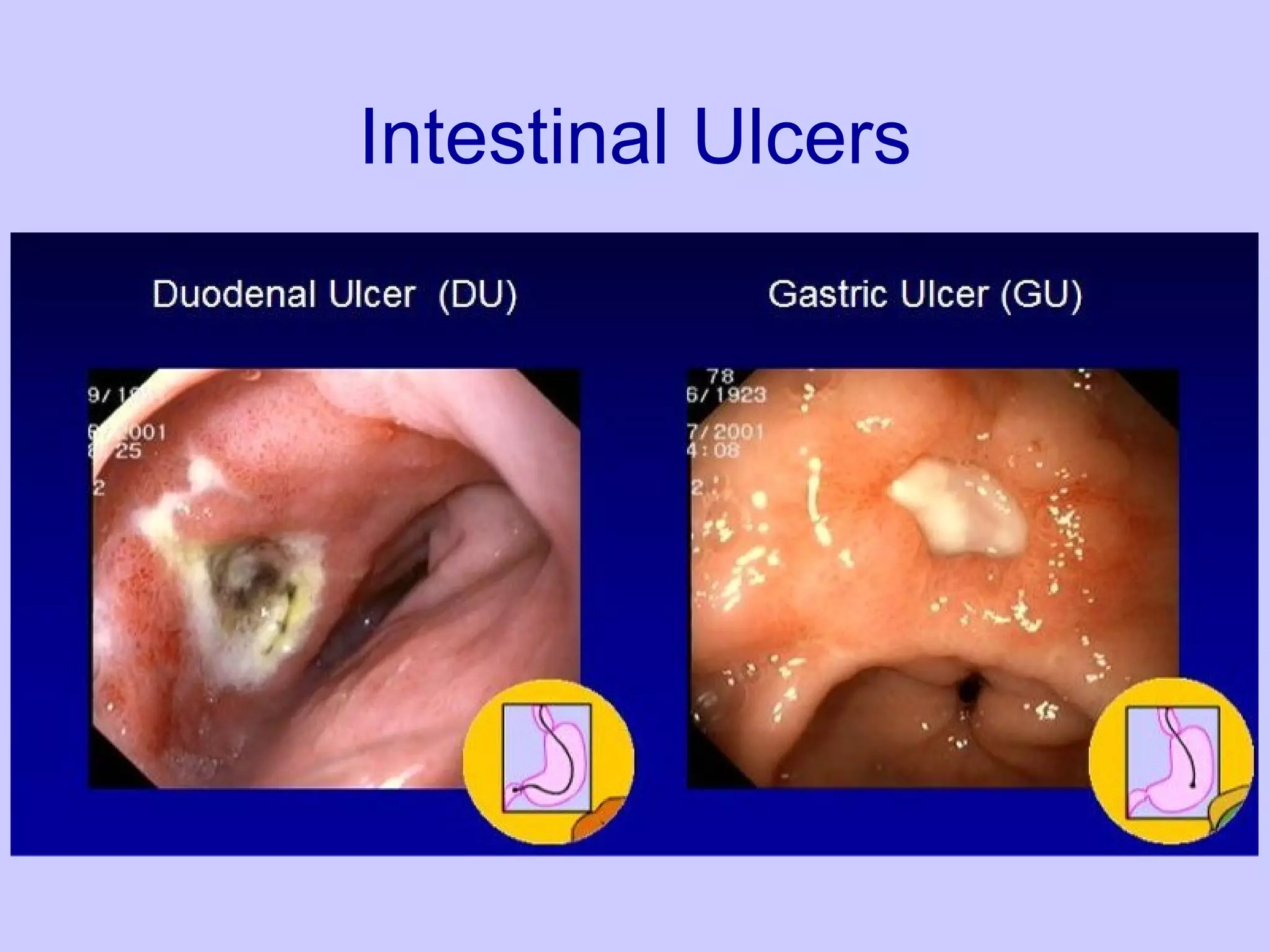 Intestinal Ulcers 
