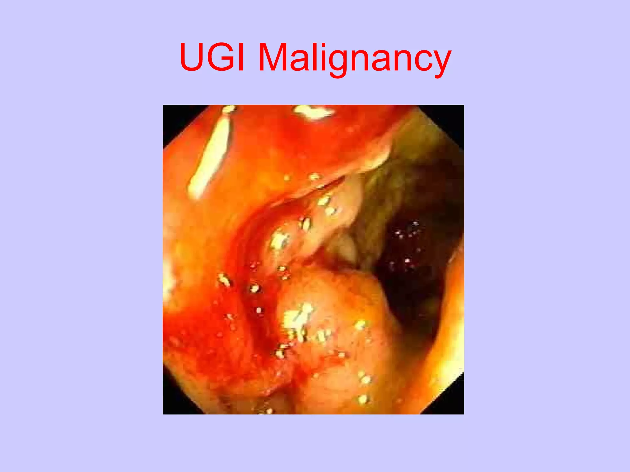 UGI   Malignancy 