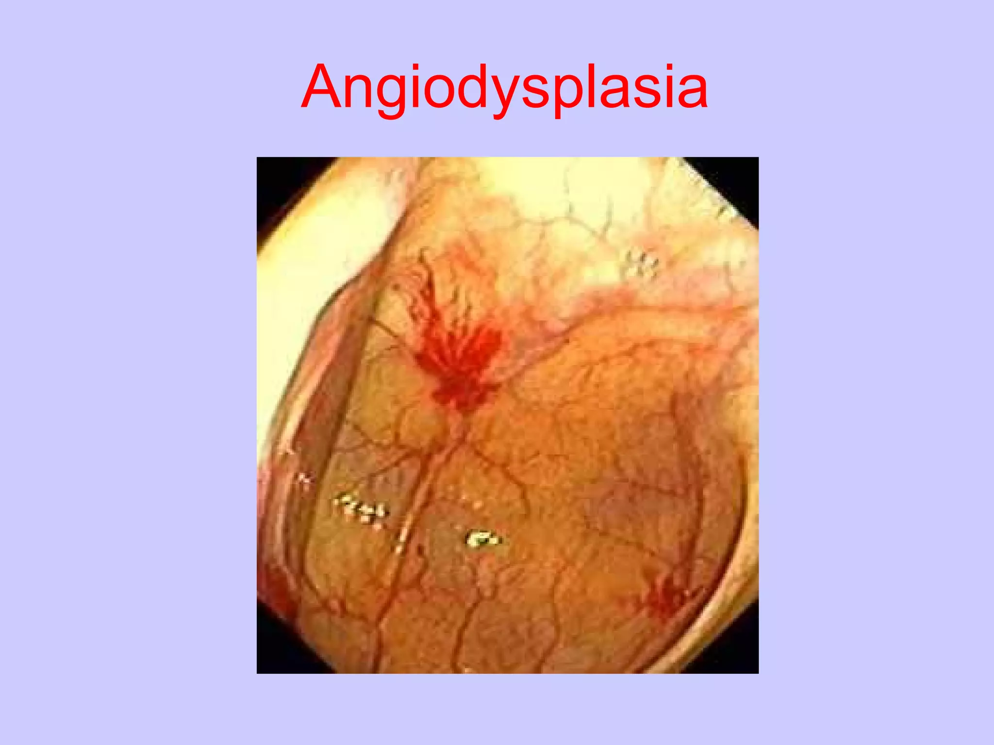 Angiodysplasia 