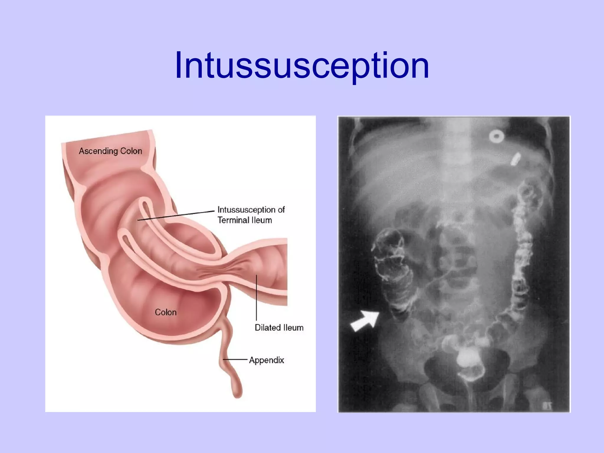 Intussusception 