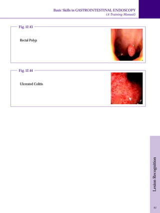 Basic Skills in GASTROINTESTINAL ENDOSCOPY 
(A Training Manual) 
Lesion Recognition 
91 
Fig. 12.43 
Rectal Polyp 
Fig. 12.44 
Ulcerated Colitis 
 