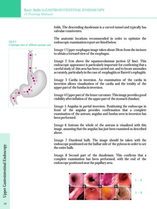 Basic Skills in GASTROINTESTINAL ENDOSCOPY 
(A Training Manual) 
folds. The descending duodenum is a curved tunnel and typically has 
valvulae conniventes. 
The anatomic locations recommended in order to optimize the 
endoscopic examination report are listed below. 
Image 1 Upper esophagus image taken about 20cm from the incisors 
to obtain a forward view of the esophagus. 
Image 2 2cm above the squamocolumnar juction (Z line). This 
endoscopic appearance is particularly important for confirming that a 
careful study of this area has been carried out, and to locate anomalies 
accurately, particularly in the case of esophagitis or Barrett's esphagitis 
Image 3 Cardia in inversion. An examination of the cardia in 
inversion allows visualization of the cardia and the totality of the 
upper part of the fundus in inversion. 
Image4 Upper part of the lesser curvature. This image provides good 
visibility after inflation of the upper part of the stomach (fundus). 
Image 5 Angulus in partial inversion. Positioning the endoscope in 
front of the angulus provides confirmation that a complete 
examination of the antrum, angulus and fundus seen in inversion has 
been performed. 
Image 6 Antrum the whole of the antrum is visualized with this 
image, assuming that the angulus has just been examined as described 
above. 
Image 7 Duodenal bulb. The image should be taken with the 
endoscope positioned on the bulbar side of the pylorus in order to see 
the entire bulb. 
Image 8 Second part of the duodenum. This confirms that a 
complete examination has been performed, with the end of the 
endoscope positioned near the papillary area. 
Fig 8.4 
Endoscopic views of different anatomic sites 
1 
2 
3 
4 
5 
6 
7 
8 
58 Upper Gastrointestinal Endoscopy 
1 -- 4 
5 -- 8 
 