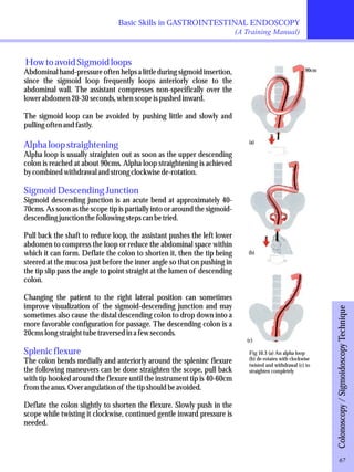 Basic Skills in GASTROINTESTINAL ENDOSCOPY 
(A Training Manual) 
How to avoid Sigmoid loops 
Abdominal hand-pressure often helps a little during sigmoid insertion, 
since the sigmoid loop frequently loops anteriorly close to the 
abdominal wall. The assistant compresses non-specifically over the 
lower abdomen 20-30 seconds, when scope is pushed inward. 
The sigmoid loop can be avoided by pushing little and slowly and 
pulling often and fastly. 
Alpha loop straightening 
Alpha loop is usually straighten out as soon as the upper descending 
colon is reached at about 90cms. Alpha loop straightening is achieved 
by combined withdrawal and strong clockwise de-rotation. 
Sigmoid Descending Junction 
Sigmoid descending junction is an acute bend at approximately 40- 
70cms. As soon as the scope tip is partially into or around the sigmoid-descending 
junction the following steps can be tried. 
Pull back the shaft to reduce loop, the assistant pushes the left lower 
abdomen to compress the loop or reduce the abdominal space within 
which it can form. Deflate the colon to shorten it, then the tip being 
steered at the mucosa just before the inner angle so that on pushing in 
the tip slip pass the angle to point straight at the lumen of descending 
colon. 
Changing the patient to the right lateral position can sometimes 
improve visualization of the sigmoid-descending junction and may 
sometimes also cause the distal descending colon to drop down into a 
more favorable configuration for passage. The descending colon is a 
20cms long straight tube traversed in a few seconds. 
Splenic flexure 
The colon bends medially and anteriorly around the spleninc flexure 
the following maneuvers can be done straighten the scope, pull back 
with tip hooked around the flexure until the instrument tip is 40-60cm 
from the anus. Over angulation of the tip should be avoided. 
Deflate the colon slightly to shorten the flexure. Slowly push in the 
scope while twisting it clockwise, continued gentle inward pressure is 
needed. 
Colonoscopy / Sigmoidoscopy Technique 
(a) 
(b) 
(c) 
90cm 
Fig 10.3 (a) An alpha loop 
(b) de-rotates with clockwise 
twisted and withdrawal (c) to 
straighten completely 
67 
 