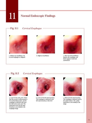 11 Normal Endoscopic Findings 
Fig. 11.1 Cervical Esophagus 
a. Without air insufflation, the 
cervical esophagus is collapsed 
b. Slight air insufflation c. More forceful insufflation 
distance the esophagus, and 
lumen appears round and 
symmetrical 
Fig. 11.2 Cervical Esophagus 
a. Level of the aortic arch. Notice 
that this section is still proximal to 
the tracheal bifuracation, and the 
esophagus is indented only from 
the side by the aortic arch. The 
Impression from the left main 
bronchus is seen distally in the 
esophagus image 
b. Level of the left main bronchus. 
The esophagus is indented by the 
left main bronchus at this level 
c. Below the left main bronchus. 
The esophagus is indented only by 
the spinal column. The cardiac 
impression is seen distally in the 
image 
71 
 
