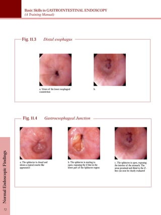 Basic Skills in GASTROINTESTINAL ENDOSCOPY 
(A Training Manual) 
Fig. 11.3 Distal esophagus 
a. Views of the lower esophageal 
constriction 
Fig. 11.4 Gastroesophageal Junction 
b. 
a. The sphincter is closed and 
shows a typical rosette like 
appearance 
b. The sphincter is starting to 
open, exposing the Z-line in the 
lower part of the Sphincter region 
c. The sphincter is open, exposing 
the interior of the stomach. The 
areas proximal and distal to the Z-line 
can now be clearly evaluated 
Normal Endoscopic Findings 72 
 