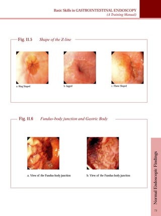 Basic Skills in GASTROINTESTINAL ENDOSCOPY 
(A Training Manual) 
Fig. 11.5 Shape of the Z-line 
a. Ring Shaped b. Jagged c. Flame Shaped 
Fig. 11.6 Fundus-body junction and Gastric Body 
Normal Endoscopic Findings 
73 
a. View of the Fundus-body junction b. View of the Fundus-body junction 
 