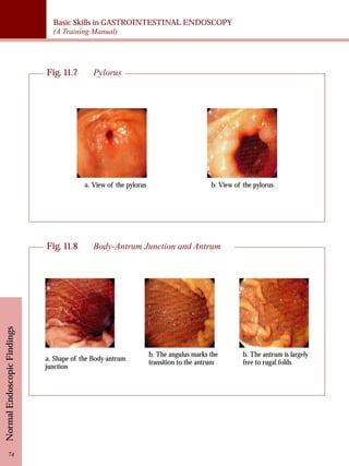 Basic Skills in GASTROINTESTINAL ENDOSCOPY 
(A Training Manual) 
Normal Endoscopic Findings 74 
Fig. 11.7 Pylorus 
a. View of the pylorus b. View of the pylorus 
Fig. 11.8 Body-Antrum Junction and Antrum 
a. Shape of the Body-antrum 
junction 
b. The angulus marks the 
transition to the antrum 
b. The antrum is largely 
free to rugal folds 
 