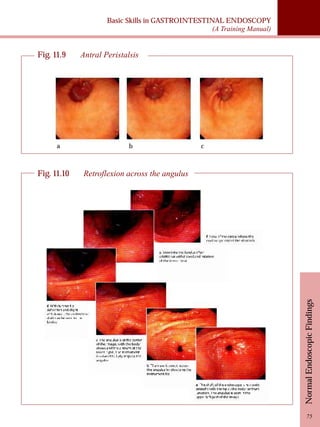Basic Skills in GASTROINTESTINAL ENDOSCOPY 
(A Training Manual) 
Normal Endoscopic Findings 
75 
Fig. 11.9 Antral Peristalsis 
a b c 
Fig. 11.10 Retroflexion across the angulus 
 