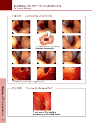 Basic Skills in GASTROINTESTINAL ENDOSCOPY 
(A Training Manual) 
Normal Endoscopic Findings 76 
Fig. 11.11 Maneuvering the endoscope 
a-h The fundus is inspected by a combination 
of angling and rotation maneuvers 
i-k The fundus is approched by withdrawing the instrument 
Fig. 11.12 View into the duodenal bulb 
A small pool of fluid is visible at 
approximately the 11-o’ clock position 
 