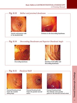 Basic Skills in GASTROINTESTINAL ENDOSCOPY 
(A Training Manual) 
Normal Endoscopic Findings 
77 
Fig. 11.13 Bulbar and proximal duodenum 
Anterior and posterior walls 
of the duodenal bulb 
Entrance to the descending duodenum 
Fig. 11.14 Descending Duodenum and Superior Duodenal Angle 
Descending duodenum Junction of the bulbar and 
descending duodenum 
Fig. 11.15 Duodenal Bulb 
Normal Duodenal bulb 
Notice the rounded. 
oblong shape 
Normal Duodenal bulb 
Notice the granular mucosal 
surface 
Normal Duodenal bulb 
The relatively coarse granular 
pattern of the mucosa is normal variant 
 