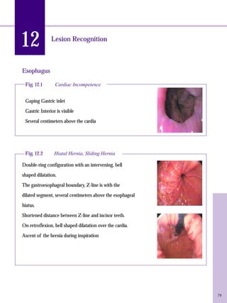 12 
Lesion Recognition 
Esophagus 
Fig. 12.1 Cardiac Incompetence 
Gaping Gastric inlet 
Gastric Interior is visible 
Several centimeters above the cardia 
Fig. 12.2 Hiatal Hernia, Sliding Hernia 
Double-ring configuration with an intervening, bell 
shaped dilatation. 
The gastroesophageal boundary, Z-line is with the 
dilated segment, several centimeters above the esophageal 
hiatus. 
Shortened distance between Z-line and incisor teeth. 
On retroflexion, bell shaped dilatation over the cardia. 
Ascent of the hernia during inspiration 
79 
 