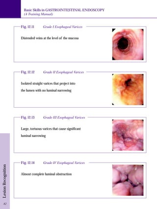 Basic Skills in GASTROINTESTINAL ENDOSCOPY 
(A Training Manual) 
Lesion Recognition 
Fig. 12.11 Grade I Esophageal Varices 
Distended veins at the level of the mucosa 
Fig. 12.12 Grade II Esophageal Varices 
Isolated straight varices that project into 
the lumen with no luminal narrowing 
Fig. 12.13 Grade III Esophageal Varices 
Large, tortuous varices that cause significant 
luminal narrowing 
Fig. 12.14 Grade IV Esophageal Varices 
Almost complete luminal obstruction 
82 
 