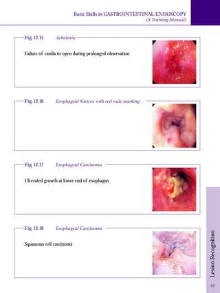 Basic Skills in GASTROINTESTINAL ENDOSCOPY 
(A Training Manual) 
Lesion Recognition 
Fig. 12.15 Achalasia 
Failure of cardia to open during prolonged observation 
Fig. 12.16 Esophageal Varices with red wale marking 
83 
Fig. 12.17 Esophageal Carcinoma 
Ulcerated growth at lower end of esophagus 
Fig. 12.18 Esophageal Carcinoma 
Squamous cell carcinoma 
 
