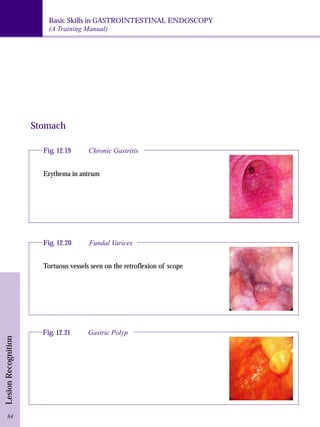 Basic Skills in GASTROINTESTINAL ENDOSCOPY 
(A Training Manual) 
Lesion Recognition 
Fig. 12.19 Chronic Gastritis 
Erythema in antrum 
Fig. 12.21 Gastric Polyp 
84 
Stomach 
Fig. 12.20 Fundal Varices 
Tortuous vessels seen on the retroflexion of scope 
 