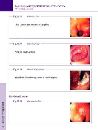Basic Skills in GASTROINTESTINAL ENDOSCOPY 
(A Training Manual) 
Lesion Recognition 
Fig. 12.26 Gastric Ulcer 
Ulcer Located just proximal to the pylora 
Fig. 12.27 Gastric Polyp 
Polypoid was in Antrum 
Fig. 12.28 Gastric Carcinoma 
Retroflexed view showing tumor in cardiac region 
Duodenal Lesion 
Fig. 12.29 Duodenal Ulcer 
86 
 