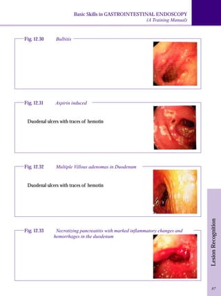 Basic Skills in GASTROINTESTINAL ENDOSCOPY 
Fig. 12.33 Necrotizing pancreatitis with marked inflammatory changes and 
hemorrhages in the duodenum 
(A Training Manual) 
Lesion Recognition 
Fig. 12.30 Bulbitis 
Fig. 12.31 Aspirin induced 
Duodenal ulcers with traces of hemotin 
Fig. 12.32 Multiple Villous adenomas in Duodenum 
Duodenal ulcers with traces of hemotin 
87 
 