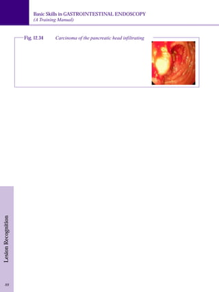 Basic Skills in GASTROINTESTINAL ENDOSCOPY 
(A Training Manual) 
Lesion Recognition 
Fig. 12.34 Carcinoma of the pancreatic head infiltrating 
88 
 