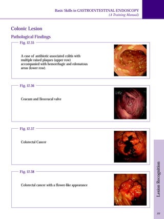 Basic Skills in GASTROINTESTINAL ENDOSCOPY 
(A Training Manual) 
Lesion Recognition 
Colonic Lesion 
89 
Pathological Findings 
Fig. 12.35 
A case of antibiotic-associated colitis with 
multiple raised plaques (upper row) 
accompanied with hemorrhagic and edematous 
areas (lower row). 
Fig. 12.36 
Ceacum and Ileoceacal valve 
Fig. 12.37 
Colorectal Cancer 
Fig. 12.38 
Colorectal cancer with a flower-like appearance 
 