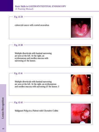 Basic Skills in GASTROINTESTINAL ENDOSCOPY 
(A Training Manual) 
Lesion Recognition 90 
Fig. 12.39 
colorectal cancer with central excavation 
Fig. 12.40 
Multiple diverticula with luminal narrowing 
are seen at the left. At the right, an 
erythematous and swollen mucosa with 
narrowing of the lumen. 
Fig. 12.41 
Multiple diverticula with luminal narrowing 
are seen at the left. At the right, an erythematous 
and swollen mucosa with narrowing of the lumen. 2 
Fig. 12.42 
Malignant Polyp in a Patient with Ulcerative Colitis 
 