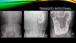 Intestino Normal GASTROINTESTINAL INTESTINO DELGADO.pptxx | PPTX