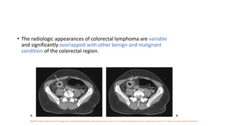 • The radiologic appearances of colorectal lymphoma are variable
and significantly overlapped with other benign and malignant
condition of the colorectal region.
 