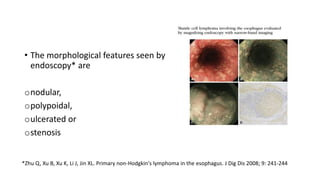 • The morphological features seen by
endoscopy* are
onodular,
opolypoidal,
oulcerated or
ostenosis
*Zhu Q, Xu B, Xu K, Li J, Jin XL. Primary non-Hodgkin's lymphoma in the esophagus. J Dig Dis 2008; 9: 241-244
 
