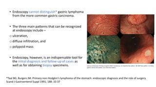 • Endoscopy cannot distinguish* gastric lymphoma
from the more common gastric carcinoma.
• The three main patterns that can be recognized
at endoscopy include –
o ulceration,
o diffuse infiltration, and
o polypoid mass
• Endoscopy, however, is an indispensable tool for
the initial diagnosis and follow-up of cases as
well as for obtaining biopsy specimens.
*Taal BG, Burgers JM. Primary non-Hodgkin's lymphoma of the stomach: endoscopic diagnosis and the role of surgery.
Scand J Gastroenterol Suppl 1991; 188: 33-37
 