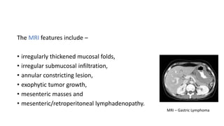 The MRI features include –
• irregularly thickened mucosal folds,
• irregular submucosal infiltration,
• annular constricting lesion,
• exophytic tumor growth,
• mesenteric masses and
• mesenteric/retroperitoneal lymphadenopathy.
MRI – Gastric Lymphoma
 