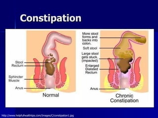 Constipation http://www.helpfulhealthtips.com/Images/C/constipation1.jpg 