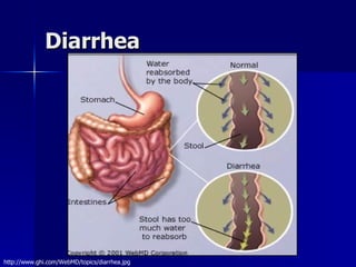 Diarrhea http://www.ghi.com/WebMD/topics/diarrhea.jpg 