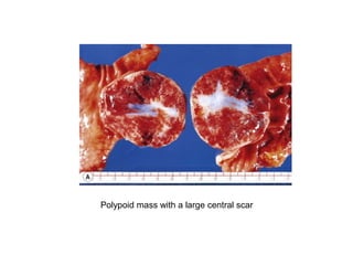 Polypoid mass with a large central scar
 