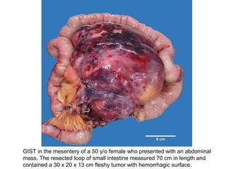 GIST in the mesentery of a 50 y/o female who presented with an abdominal
mass. The resected loop of small intestine measured 70 cm in length and
contained a 30 x 20 x 13 cm fleshy tumor with hemorrhagic surface.
 