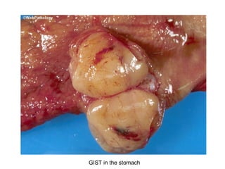 GIST in the stomach
 