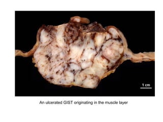 An ulcerated GIST originating in the muscle layer
 