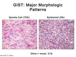 GIST: Major Morphologic
Patterns
Spindle Cell (70%) Epithelioid (9%)
urtesy of Dr. C. Corless.
Other-> mixed 21%
 