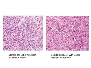 Spindle cell GIST with short
fascicles & whorls
Spindle cell GIST with longer
fascicles in bundles
 
