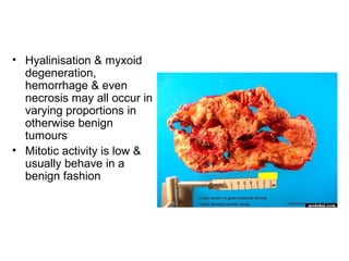 • Hyalinisation & myxoid
degeneration,
hemorrhage & even
necrosis may all occur in
varying proportions in
otherwise benign
tumours
• Mitotic activity is low &
usually behave in a
benign fashion
 