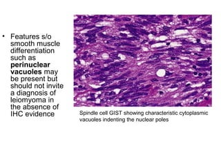 • Features s/o
smooth muscle
differentiation
such as
perinuclear
vacuoles may
be present but
should not invite
a diagnosis of
leiomyoma in
the absence of
IHC evidence Spindle cell GIST showing characteristic cytoplasmic
vacuoles indenting the nuclear poles
 